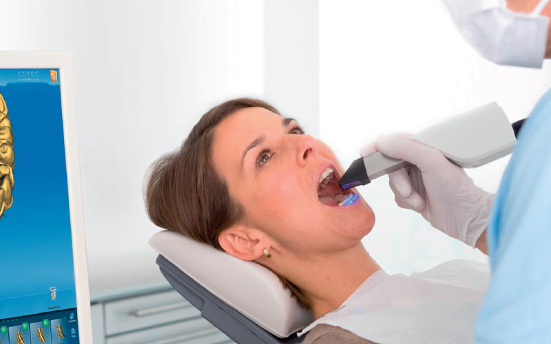 Dentista impronta digitale veloce e non invasiva